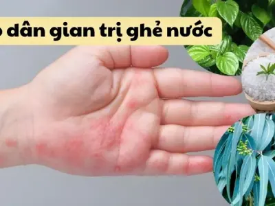 Cách dùng mẹo dân gian trị ghẻ nước không để lại sẹo