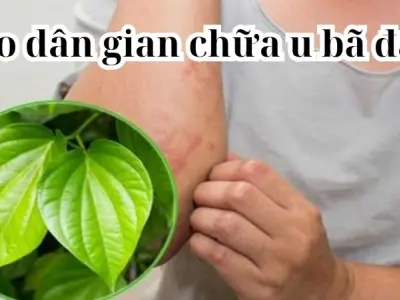 Mẹo dân gian chữa u bã đậu được lưu truyền nhiều đời