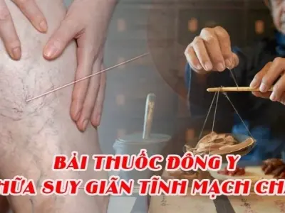 Hé lộ mẹo dân gian chữa giãn tĩnh mạch từ ngàn đời xưa
