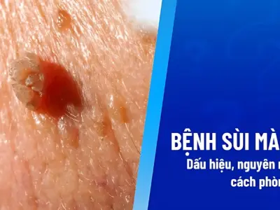 Sùi mào gà là gì? Bệnh lý lây truyền phổ biến bạn cần biết