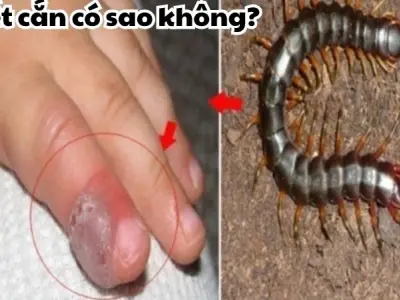 Bị rết cắn có sao không và cách xử lý đúng chuẩn tại nhà