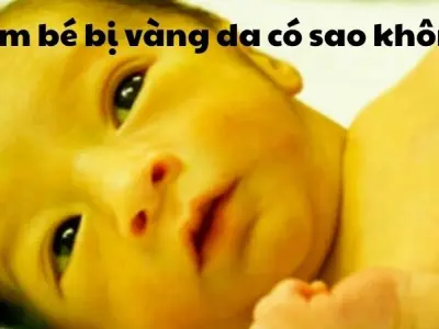 Em bé bị vàng da có sao không? Cha mẹ đừng chủ quan