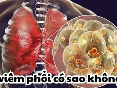 Bị viêm phổi có sao không và cách nhận biết sớm nhất