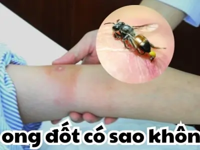 Bị ong đốt có sao không và cách xử lý an toàn tại nhà