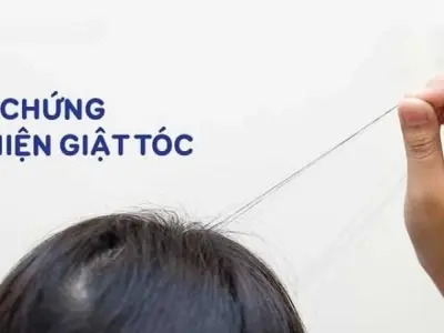 Bị hội chứng nghiện giật tóc có sao không và cách xử lý