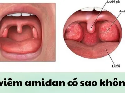Bị viêm amidan có sao không và khi nào cần cắt bỏ gấp
