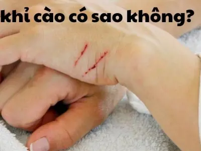 Bị khỉ cào có sao không và các bệnh lý cần lưu ý ngay