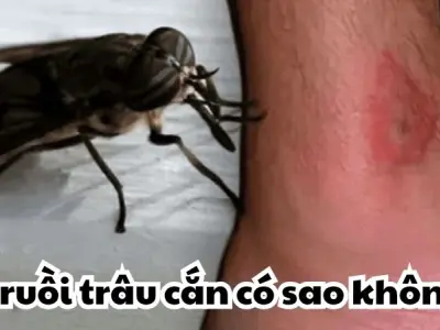 Bị ruồi trâu cắn có sao không và mối nguy tiềm ẩn khó lường