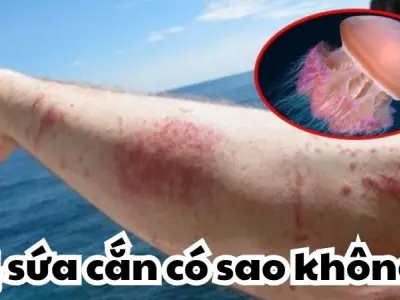 Bị sứa cắn có sao không và cách xử lý an toàn kịp thời