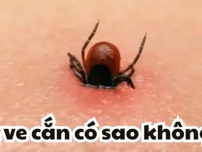 Bị ve cắn có sao không và các bước xử lý khẩn cấp an toàn