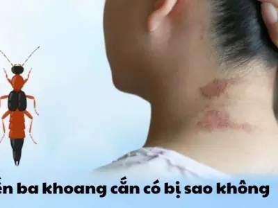 Kiến ba khoang cắn có bị sao không và cách phòng ngừa