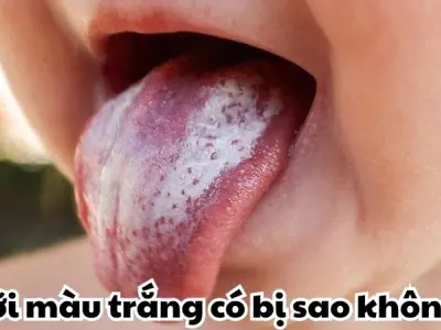 Lưỡi màu trắng có bị sao không và khi nào cần đi khám