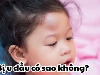 Bị u đầu có sao không và làm thế nào để giảm đau hiệu quả