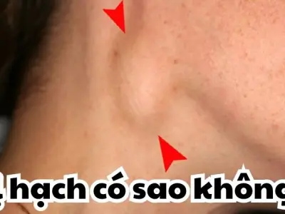 Bị hạch có sao không - Dấu hiệu cảnh báo bệnh lý nguy hiểm