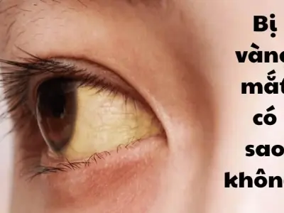 Bị vàng mắt có sao không và cách khắc phục nhanh chóng