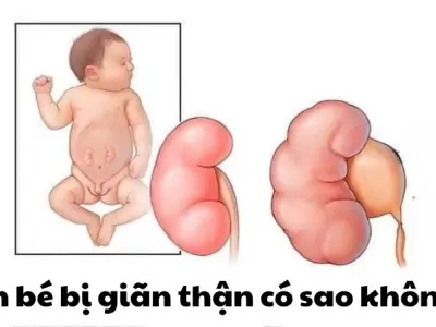 Em bé bị giãn thận có sao không - Cha mẹ cần làm gì ngay
