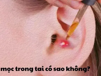Mụn mọc trong tai có bị sao không cần lưu ý những gì
