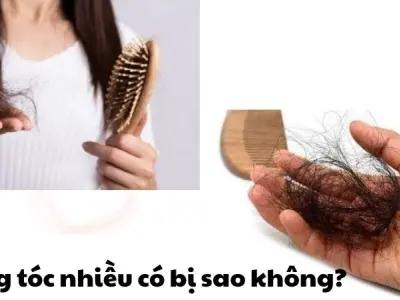 Rụng tóc nhiều có bị sao không và cách xử lý kịp thời