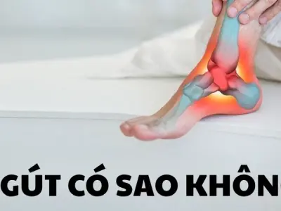 Bị gút có sao không và cách xử lý khi cơn đau ập đến