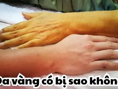 Da vàng có bị sao không - Dấu hiệu nguy hiểm cần biết ngay
