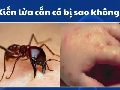 Kiến lửa cắn có bị sao không và cách xử lý tại nhà