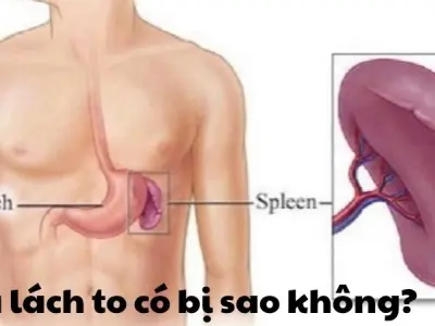 Lá lách to có bị sao không? Nguyên nhân và cách xử lý