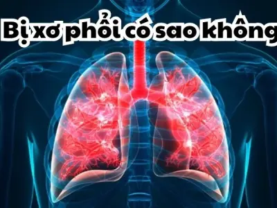 Bị xơ phổi có sao không và khả năng phục hồi ra sao