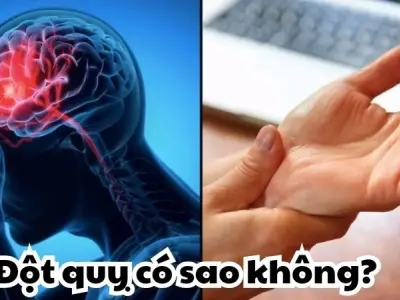 Bị đột quỵ có sao không - Đừng bỏ lỡ thời gian vàng