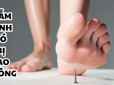 Giẫm đinh có bị sao không và cách xử khẩn cấp kịp thời