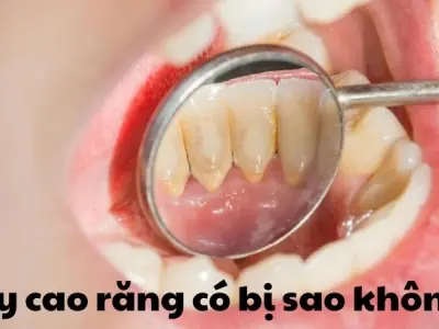 Lấy cao răng có bị sao không và sự thật nhiều người bỏ qua