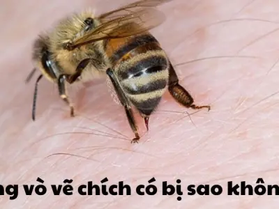 Ong vò vẽ chích có bị sao không - Cách xử lý hiệu quả