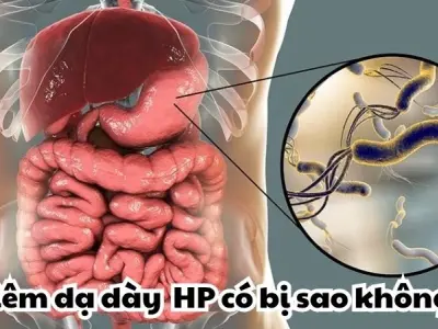 Viêm dạ dày HP có bị sao không và dấu hiệu cảnh báo