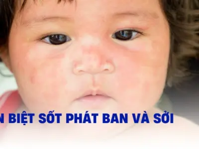 Cách phân biệt sởi và sốt phát ban chính xác ngay tại nhà