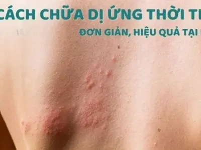 Bật mí mẹo dân gian chữa dị ứng thời tiết đơn giản tại nhà