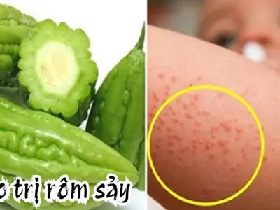 Trị rôm sảy không cần thuốc nhờ mẹo dân gian cổ truyền