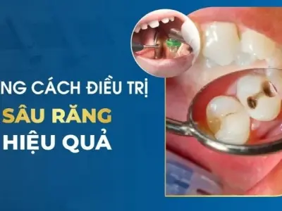 Trị dứt điểm sâu răng nhờ mẹo dân gian hiệu nghiệm