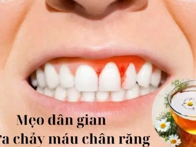 Chia sẻ mẹo dân gian chữa chảy máu chân răng đơn giản nhất