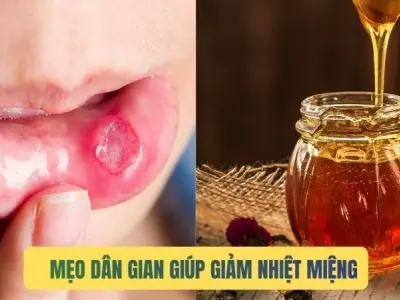 Bí quyết dân gian trị nhiệt miệng hiệu quả an toàn tự nhiên