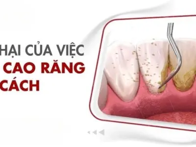 Tưởng vô hại nhưng lấy cao răng sai cách gây họa thế nào