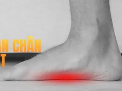 Chuyên gia cảnh báo tác hại bàn chân bẹt ít ai nghĩ tới