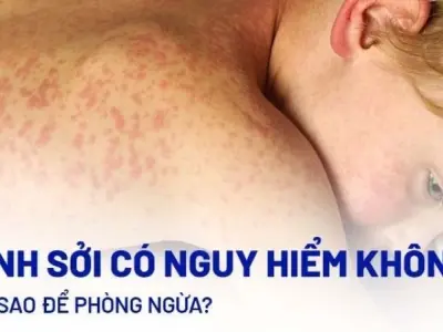Cảnh báo tác hại bệnh sởi gây biến chứng nguy hiểm toàn cầu