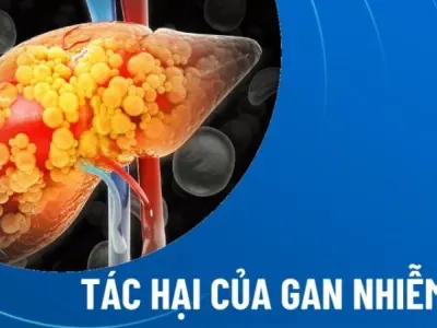 Hiểu rõ tác hại của gan nhiễm mỡ để bảo vệ sức khỏe tối ưu