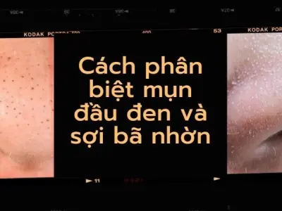 Cách phân biệt mụn đầu đen và sợi bã nhờn chính xác 100%