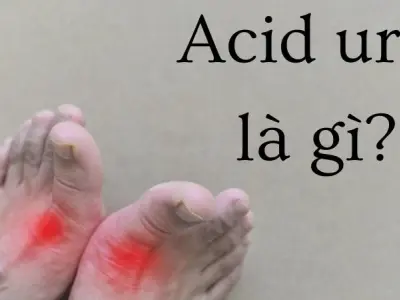 Acid uric là gì? Dấu hiệu ban đêm bạn không ngờ tới sớm