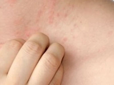 Bí quyết chữa mề đay bằng mẹo dân gian hiệu quả tại nhà