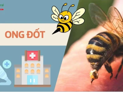 Mẹo Dân Gian Chữa Ong Đốt Hiệu Quả Ngay Tại Nhà