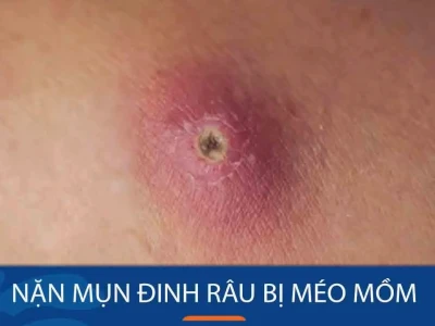 Nặn mụn đinh râu bị méo mồm: Nguyên nhân và cách xử lý an toàn