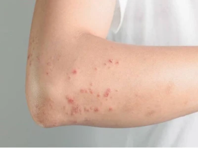 Nhiễm Giun Đũa Chó Mèo: Nguyên Nhân Gây Dị Ứng Da và Cách Xử Lý Hiệu Quả