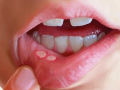 Những tác hại tiềm ẩn của bột quế bạn cần biết