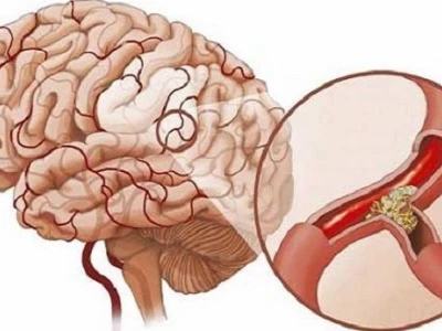 Phân biệt Nhồi máu não và Xuất huyết não: Nhận biết sớm, Cứu sống kịp thời